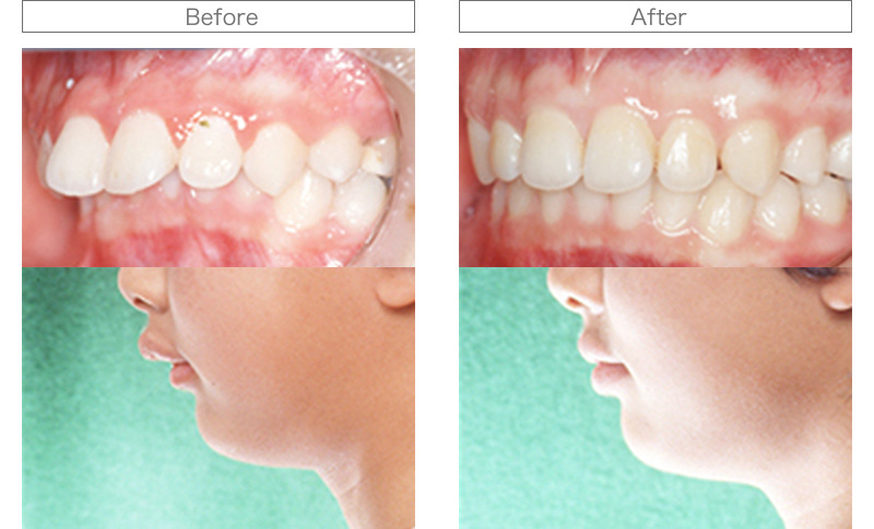 矯正歯科治療 Before/After写真