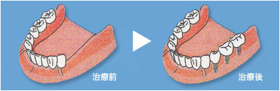 部分入れ歯とインプラントの比較