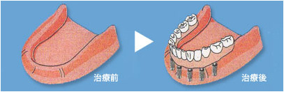 総入れ歯とインプラントの比較