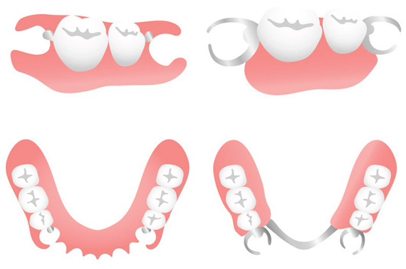 ノンクラスプデンチャーと保険適用の部分入れ歯